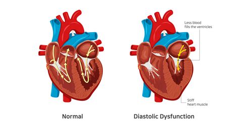 diastolic dysfunction grade 1 meaning.